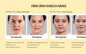 Làm Trắng Da Bằng Công Nghệ Nano